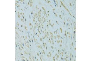 Immunohistochemistry of paraffin-embedded human uterine cancer using UGT1A6 antibody (ABIN4905553) at dilution of 1:100 (40x lens). (UGT1A6 Antikörper)