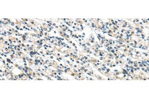 Immunohistochemistry of paraffin-embedded Human prostate cancer tissue using VPS36 Polyclonal Antibody at dilution 1:40 (VPS36 Antikörper)