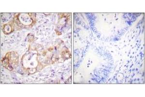 Immunohistochemistry analysis of paraffin-embedded human colon carcinoma, using Keratin 8 (Phospho-Ser432) Antibody. (KRT8 Antikörper  (pSer432))