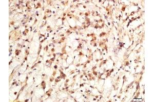 Paraformaldehyde-fixed, paraffin embedded human stomach cancer, Antigen retrieval by boiling in sodium citrate buffer (pH6) for 15min, Block endogenous peroxidase by 3% hydrogen peroxide for 30 minutes, Blocking buffer (normal goat serum) at 37°C for 20min, Antibody incubation with Rabbit Anti-Ki-67 (Proliferation Marker) Polyclonal Antibody, Unconjugated  at 1:200 overnight at 4°C, followed by a conjugated secondary for 90 minutes and DAB staining. (Ki-67 Antikörper  (AA 1201-1300))