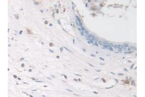 Detection of COTL1 in Human Prostate Tissue using Polyclonal Antibody to Coactosin Like Protein 1 (COTL1) (COTL1 Antikörper  (AA 1-142))