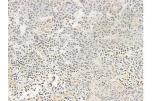 ABIN6256291 and ABIN6267489 at 1/100 staining human non-Hodgkin lymphoma by IHC-P. (Aryl Hydrocarbon Receptor Antikörper  (pSer36))