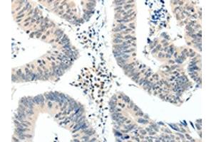 The image on the left is immunohistochemistry of paraffin-embedded Human colon cancer tissue using ABIN7192880(TRAF7 Antibody) at dilution 1/20, on the right is treated with synthetic peptide. (TRAF7 Antikörper)