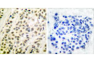 Peptide - +Immunohistochemical analysis of paraffin-embedded human breast carcinoma tissue using DP-1 antibody. (TGM4 Antikörper)