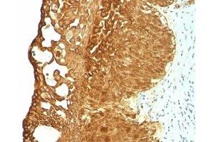 Formalin-fixed, paraffin-embedded human cervical carcinoma stained with Cytokeratin 19 antibody (KRT19/799)