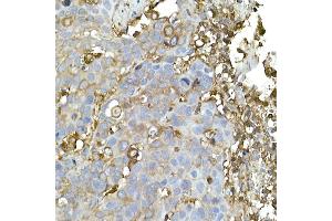 Immunohistochemistry of paraffin-embedded human esophageal cancer using C Rabbit mAb (ABIN7266058) at dilution of 1:50 (40x lens). (CAP1 Antikörper)