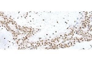 Immunohistochemistry of paraffin-embedded Human breast cancer tissue using PUM3 Polyclonal Antibody at dilution of 1:80(x200) (Pumilio 3 Antikörper)