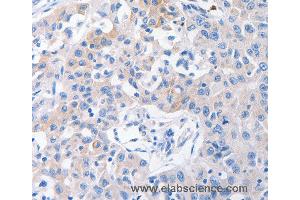 Immunohistochemistry of Human lung cancer using SLC10A1 Polyclonal Antibody at dilution of 1:31 (SLC10A1 Antikörper)