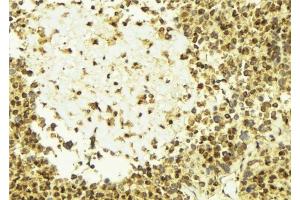 ABIN6277627 at 1/100 staining Human breast cancer tissue by IHC-P.