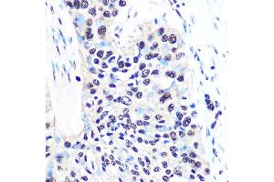 Immunohistochemistry of paraffin-embedded human esophageal cancer using NONO/p54nrb Rabbit mAb (ABIN7268947) at dilution of 1:100 (40x lens). (NONO Antikörper)