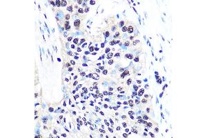 Immunohistochemistry of paraffin-embedded human esophageal cancer using NONO/p54nrb Rabbit mAb (ABIN7268947) at dilution of 1:100 (40x lens). (NONO Antikörper)