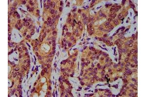 IHC image of ABIN7143840 diluted at 1:400 and staining in paraffin-embedded human liver cancer performed on a Leica BondTM system. (AASS Antikörper  (AA 224-364))