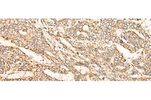 Immunohistochemistry of paraffin-embedded Human liver cancer tissue using GATD3B Polyclonal Antibody at dilution of 1:35(x200) (C21orf33 Antikörper)