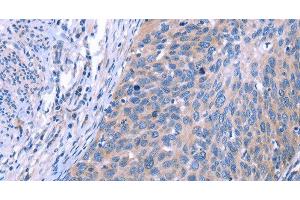 Immunohistochemistry of paraffin-embedded Human cervical cancer using ESPL1 Polyclonal Antibody at dilution of 1:40 (Separase Antikörper)