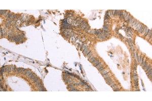 Immunohistochemistry of paraffin-embedded Human colon cancer using NAMPT Polyclonal Antibody at dilution of 1:30 (NAMPT Antikörper)