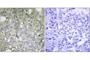 Immunohistochemistry analysis of paraffin-embedded human breast carcinoma tissue, using ADRA1D Antibody. (ADRA1D Antikörper  (AA 451-500))