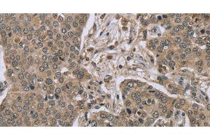Immunohistochemistry of paraffin-embedded Human liver cancer tissue using IL15RA Polyclonal Antibody at dilution 1:45 (IL15RA Antikörper)