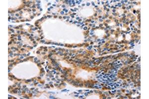 The image on the left is immunohistochemistry of paraffin-embedded Human thyroid cancer tissue using ABIN7190308(CMTM3 Antibody) at dilution 1/20, on the right is treated with synthetic peptide. (CMTM3 Antikörper)