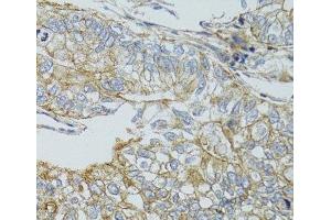 Immunohistochemistry of paraffin-embedded Human gastric cancer using CHMP4B Polyclonal Antibody at dilution of 1:100 (40x lens). (CHMP4B Antikörper)