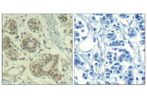 Immunohistochemical analysis of paraffin-embedded human breast carcinoma tissue using MDM2(Phospho-Ser166) Antibody(left) or the same antibody preincubated with blocking peptide(right). (MDM2 Antikörper  (pSer166))