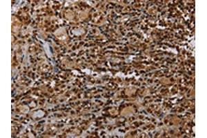 The image on the left is immunohistochemistry of paraffin-embedded Human thyroid cancer tissue using ABIN7192743(TBX5 Antibody) at dilution 1/35, on the right is treated with synthetic peptide. (T-Box 5 Antikörper)