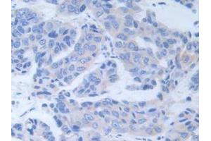IHC-P analysis of Human Breast Cancer Tissue, with DAB staining. (ALT Antikörper  (AA 255-496))