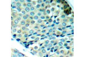 Immunohistochemistry of paraffin-embedded human breast carcinoma using Phospho-HSPB1-S78 antibody (ABIN2987689). (HSP27 Antikörper  (pSer78))