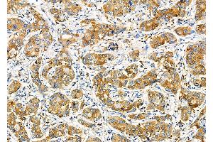 ABIN6260181 and ABIN6277800 at 1/100 staining Human liver cancer by IHC-P. (BACE1 Antikörper  (C-Term))