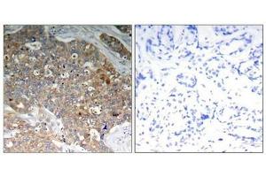 Immunohistochemical analysis of paraffin-embedded human breast carcinoma tissue using GSK3α/β(Phospho-Tyr279/216) Antibody (left) or the same antibody preincubated with blocking peptide (right). (Glycogen Synthase Kinase 3 (GSK3) (pTyr216), (pTyr279) Antikörper)