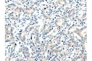 The image on the left is immunohistochemistry of paraffin-embedded Human gastric cancer tissue using ABIN7192880(TRAF7 Antibody) at dilution 1/20, on the right is treated with synthetic peptide. (TRAF7 Antikörper)