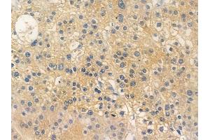 ABIN6256624 and ABIN6267265 at 1/100 staining human hepatocellular carcinoma by IHC-P. (EGFR Antikörper  (pTyr1173, pTyr1197))