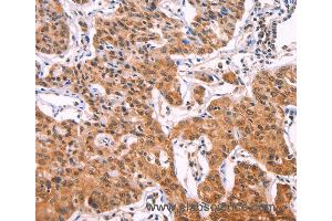 Immunohistochemistry of Human lung cancer using IL1RL1 Polyclonal Antibody at dilution of 1:70 (IL1RL1 Antikörper)
