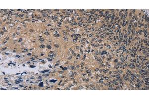 Immunohistochemistry of paraffin-embedded Human cervical cancer tissue using NOX1 Polyclonal Antibody at dilution 1:50 (NOX1 Antikörper)