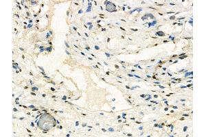 ABIN7094562 and ABIN7098611 at 1/100 staining Human ovarian cancer and adjacent normal tissues by IHC-P. (CBX1 Antikörper  (Internal Region))