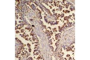 Immunohistochemical analysis of Flotillin 2 staining in human lung cancer formalin fixed paraffin embedded tissue section. (Flotillin 2 Antikörper)