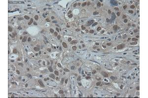 Immunohistochemical staining of paraffin-embedded Carcinoma of liver using anti-HNF6 (ABIN2452681) mouse monoclonal antibody. (ONECUT1 Antikörper  (AA 85-198))
