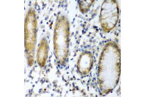 Immunohistochemistry of paraffin-embedded human colon carcinoma using SOCS2 antibody at dilution of 1:200 (40x lens).
