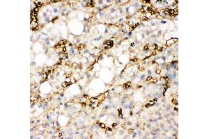 Anti-liver FABP antibody,  IHC(P) IHC(P): Human Liver Cancer Tissue (FABP1 Antikörper  (N-Term))