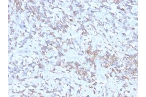Formalin-fixed, paraffin-embedded human Hepatocellular Carcinoma stained with RBP1 Recombinant Mouse Monoclonal Antibody (rRBP1/872). (Rekombinanter RBP4 Antikörper)