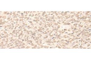 Immunohistochemistry of paraffin-embedded Human ovarian cancer tissue using RBM17 Polyclonal Antibody at dilution of 1:35(x200)