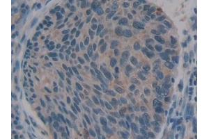 Detection of SDF1 in Human Esophagus cancer Tissue using Polyclonal Antibody to Stromal Cell Derived Factor 1 (SDF1)