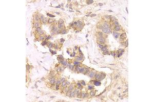 Immunohistochemistry of paraffin-embedded Human mammary cancer using CTNND1 antibody at dilution of 1:100 (x400 lens).