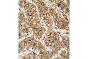 Formalin-fixed and paraffin-embedded human hepatocarcinoma tissue reacted with OE antibody (C-term) 7587b , which was peroxidase-conjugated to the secondary antibody, followed by DAB staining. (APOE Antikörper  (C-Term))