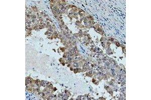 Immunohistochemical analysis of HSP70 staining in human lung cancer formalin fixed paraffin embedded tissue section. (HSP70 Antikörper)