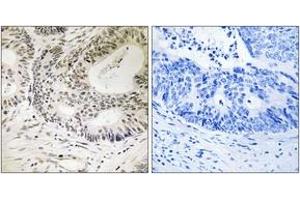 Immunohistochemistry analysis of paraffin-embedded human colon carcinoma, using 53BP1 (Phospho-Ser25) Antibody. (TP53BP1 Antikörper  (pSer25))