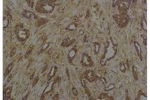 Immunohistochemical analysis of paraffin-embedded Human Breast Caricnoma using Phosphoserine Mouse mAb diluted at 1:200. (Phosphoserine Antikörper)