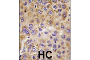 Formalin-fixed and paraffin-embedded human hepatocarcinoma tissue reacted with PFKFB1 antibody , which was peroxidase-conjugated to the secondary antibody, followed by DAB staining. (PFKFB1 Antikörper  (AA 259-289))