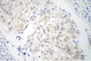 Immunohistochemistry was performed on paraffin-embedded human breast carcinoma using smad4 antibody (ABIN7800363), 1:200).