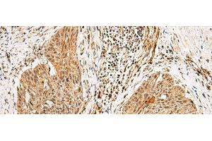 Immunohistochemistry of paraffin-embedded Human esophagus cancer tissue using GTF2H4 Polyclonal Antibody at dilution of 1:25(x200)