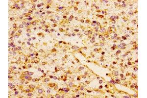 Immunohistochemistry of paraffin-embedded human glioma using ABIN7145966 at dilution of 1:100 (CCL17 Antikörper  (AA 24-94))